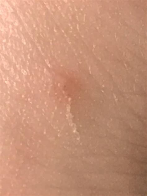 Does this look like a burrow? Ink test. : r/scabies