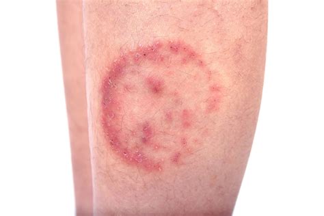 Ringworm | Cause, Symptoms, & Treatment | Britannica