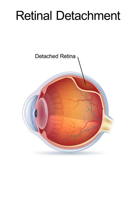 Retinal Detachment Causes: What to Know - Monterey, CA - Salinas, CA ...