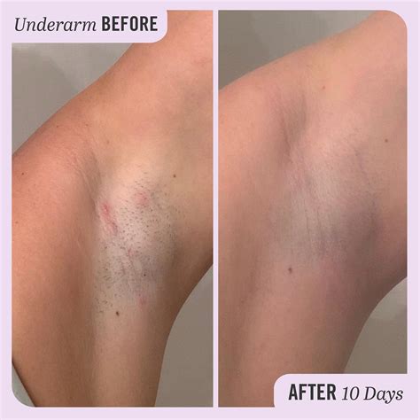 Ingrown Hair In Armpit