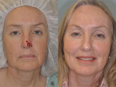 MOHS reconstruction with Forehead Flap