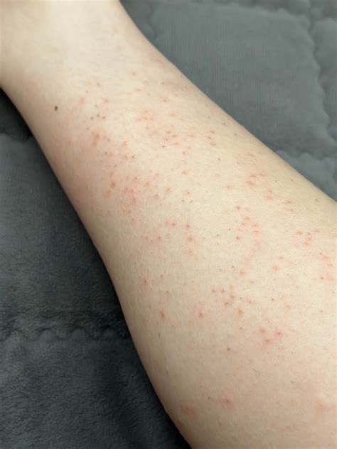 Red Bumps On Arms Not Itchy