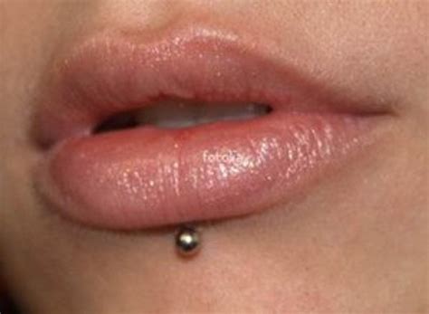 Vertical Labret Piercing Scar