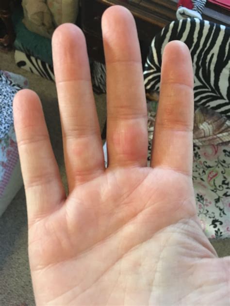 Why Do I Have Yellow Bumps On My Fingers at Benjamin Stone-wigg blog