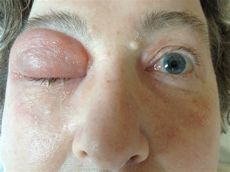 Eye Infection Cellulitis at Larry Cyr blog