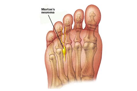 Morton’s Neuroma London UK - Foot Surgery London