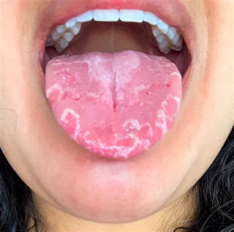 ลิ้นแตกลาย คล้ายแผนที่ ( Geographic tongue) อาการแบบนี้ อันตรายหรือไม่ รักษาอย่างไรดี - Clinic Neo