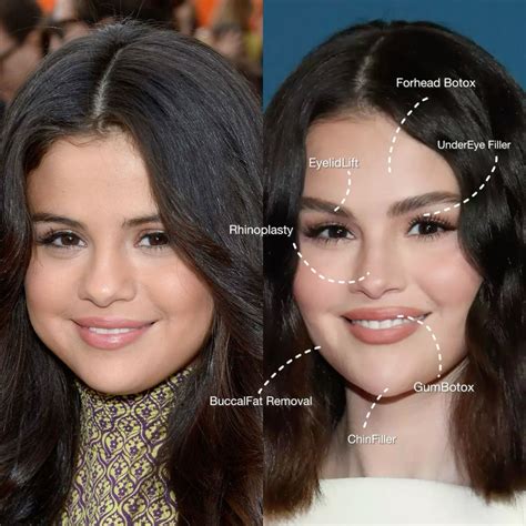 Selena Gomez before and after plastic surgery nel 2025