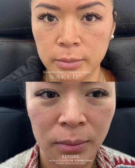 Sculptra® Filler – NAKEDMD Medspa