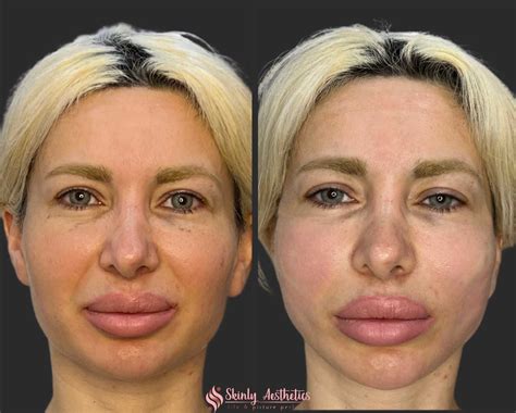 PDO Thread Lifting - Before and After Results at Skinly Aesthetics