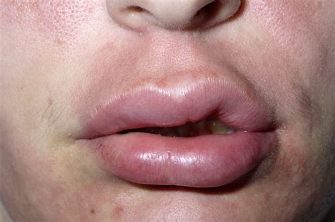 Lip Biting Meaning, Causes, Symptoms, Images, Bumps, Swollen Lip from ...