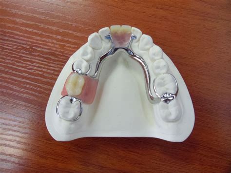 Removable Partial Denture Cast Metal Framework at Fernando Crawford blog