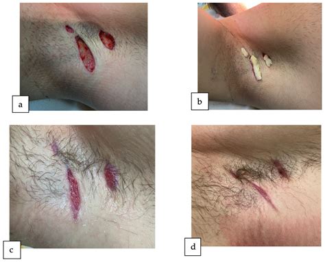 Hidradenitis Suppurativa in Association with Ulcerative Proctitis: Surgical Management in a ...