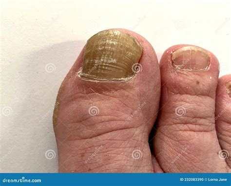 Toenail Nail Fungus - Big Toe of a Person Suffering from Onychomycosis, a Fungal Infection ...
