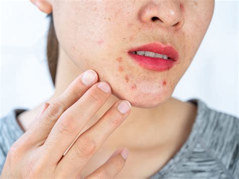 Hormonal Acne Around Mouth