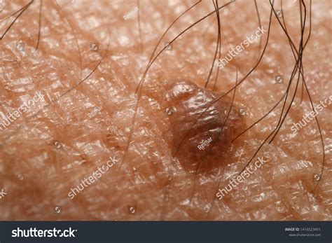 Close Skin Mole Nevus On Hairy: foto de stock (editar ahora) 1416523451