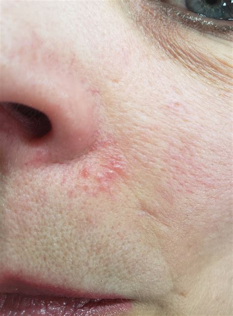 Rosacea Flare-up | My Rosacea Skin Care Regimen | Treatment to Kill Demodex Face Mites & Heal ...
