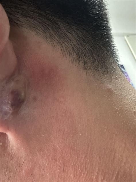 What is this soft lump behind earlobe? : r/AskDoctorSmeeee