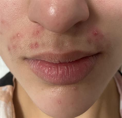 Pimple On Upper Lip