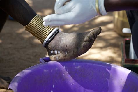 Dracunculiasis (Guinea-worm disease)