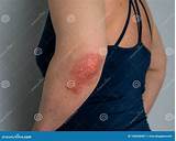 Itchy Rash On Elbows Treatment at Oliver Blesing blog