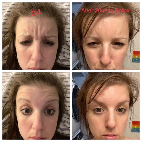 31/F- Botox b4 and after. First time! (No skin care regimen I just try to use a face wipe every ...