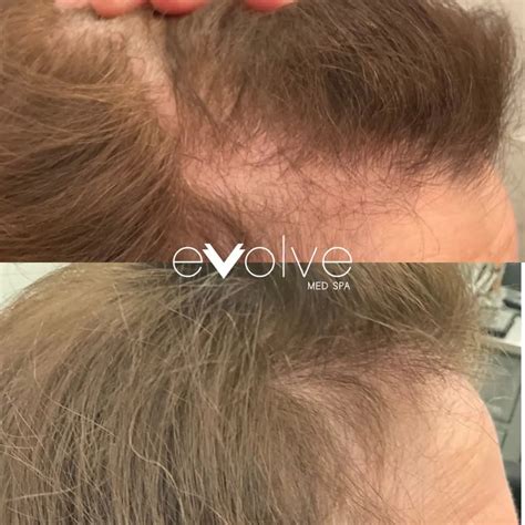 PRP Hair Restoration Results Hoboken, NJ | Evolve Med Spa