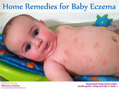 Unbelievable Tips About How To Cure Baby Eczema - Dugdrive82