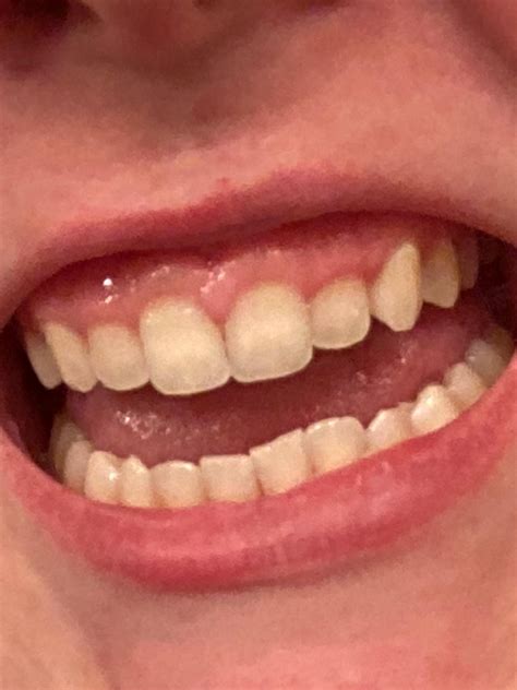 Is there any hope in saving my teeth from years of neglect and acid ...