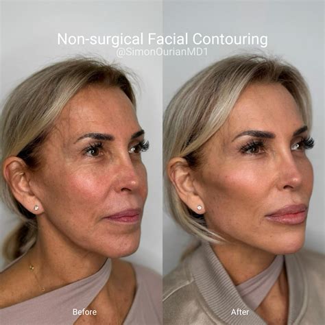 Non-surgical facial contouring in 2025 | Celebrity surgery, Facial contouring, Botox