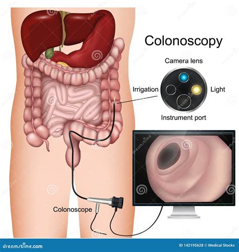 Colonoscopy Procedure Labeled 3d Diagram on White Background Stock Illustration - Illustration ...