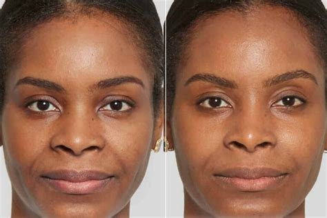 Sculptra Vancouver: Best Sculptra® Injections Clinic in BC