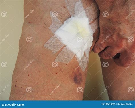Bandage and Hematomas in the Inguinal Region of a Man after Varicose Vein Surgery Stock Image ...