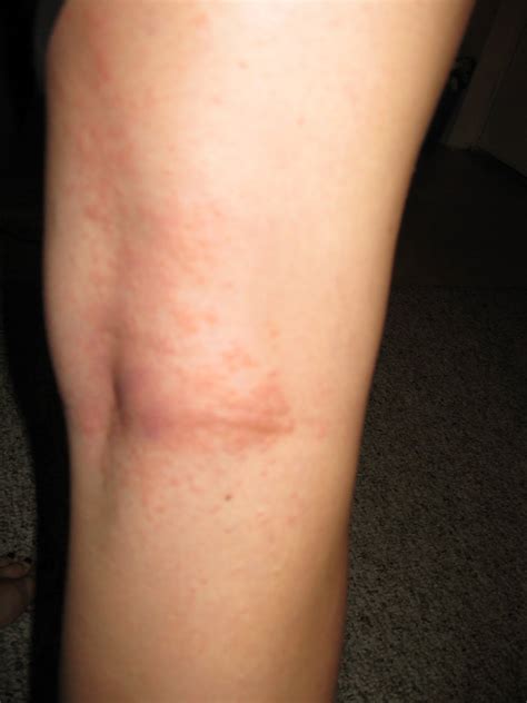 Itchy Rash On Breasts When Pregnant at Troy Jenkins blog