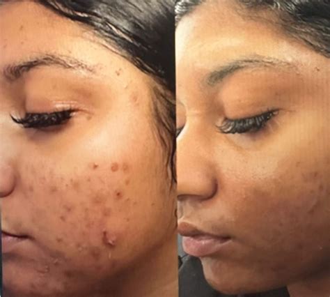 Chemical Peel For Hyperpigmentation