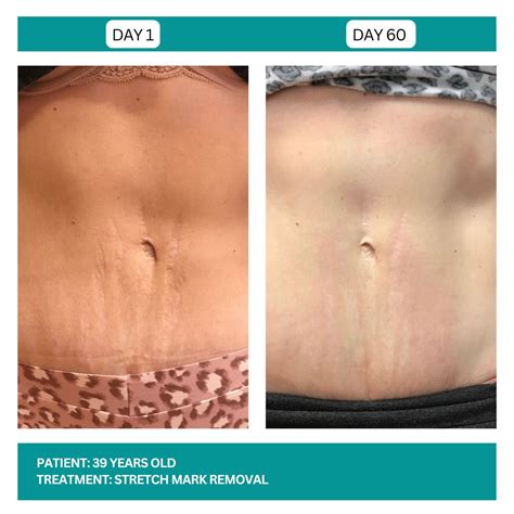 Stretch Mark Removal - Stadia Med Spa