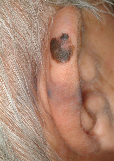 Melanoma on scalp pictures: early stage 1, scalp melanoma images ...