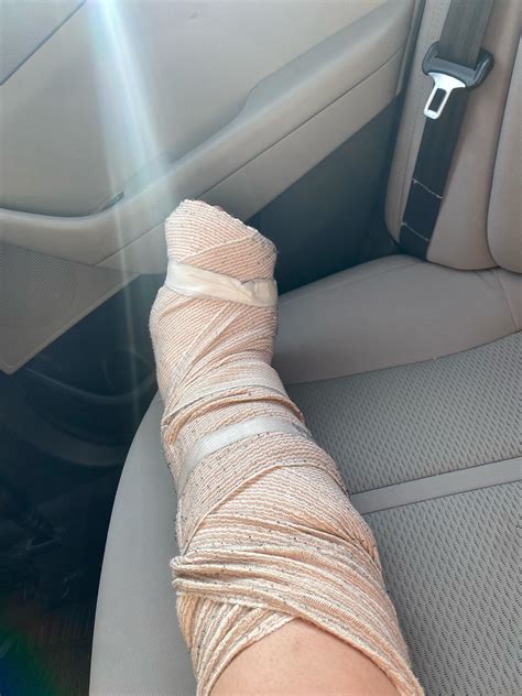 cast vs splint (opinions) : r/brokenbones