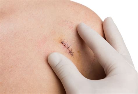 Usuwanie szwów ICD 10 | Najlepsza chińska fabryka szwów chirurgicznych