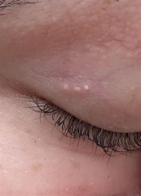 painful rash on eyelid : r/DermatologyQuestions