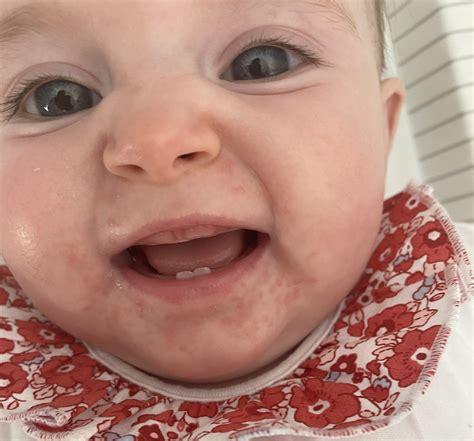 Dribble/teething rash?? | BabyCentre
