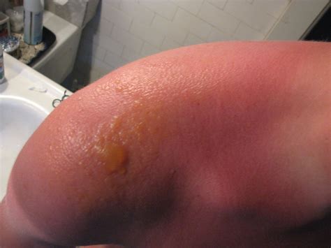 How To Cover A Burn Blister With Makeup - Mugeek Vidalondon