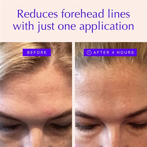 Forehead & Eye Wrinkle Patches - Overnight Anti-Wrinkle Treatment - Reduce Fine Lines & Frown ...