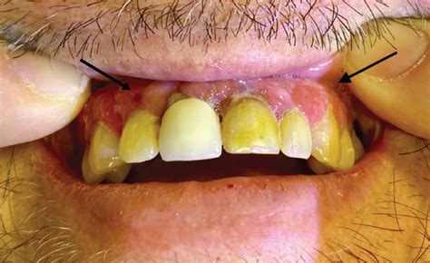 Gingival overgrowth in acute monocytic leukemia | Cleveland Clinic ...