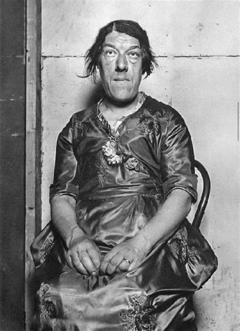 Pituitary Ademoaner: The Ugliest Woman In The World