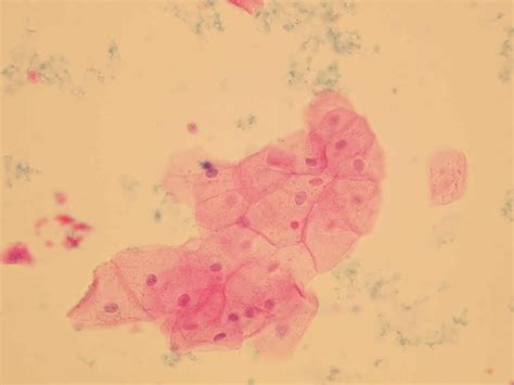 What Are Squamous Epithelial In Urine at Mai Lowder blog
