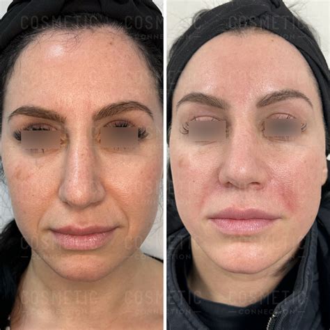 Removing Nasolabial Wrinkles Clearance | centralcountiesservices.org