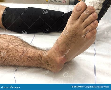 Ankle Dislocation while Doing Sports. Stock Image - Image of ...