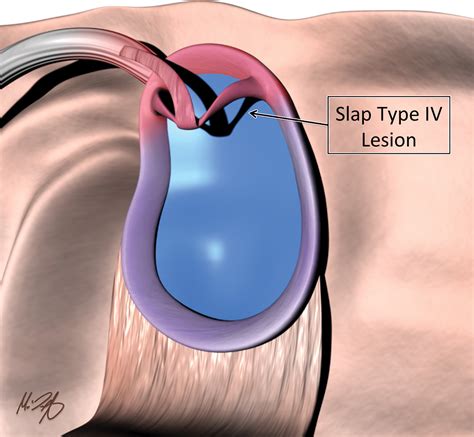 Imaging The Glenoid Labrum And Labral Tears – TRLP