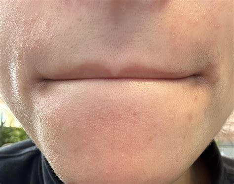 What are these white bumps near my mouth? And how to make them go away? : r/SkincareAddicts